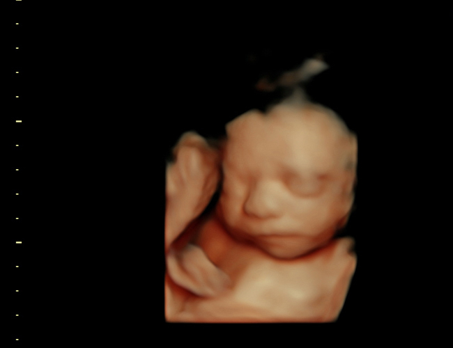 3D ultrasound image at 25 weeks